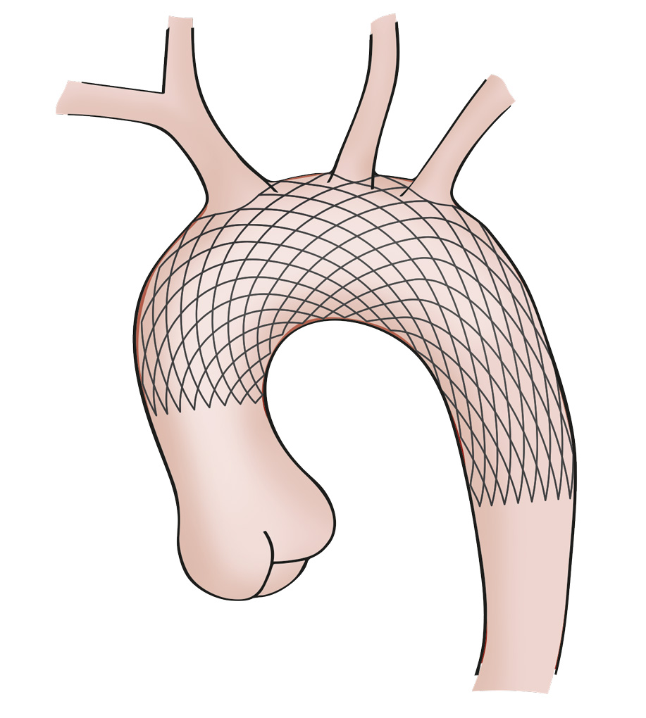 Im Rahmen des laborübergreifenden Forschungsprojekts "Aortic Gen-i-Stent" entwickelt die OTH Regensburg innovative Behandlungsmöglichkeiten durch eine additive Fertigung. Die neuen Aortenstents sollen zukünftig Leben retten.